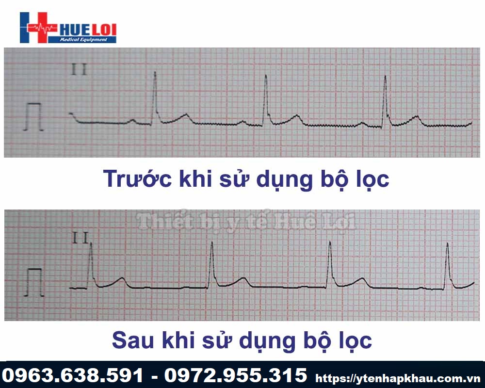 Hiệu quả bộ lọc máy điện tim